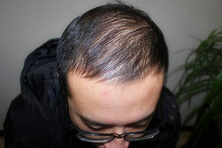 北京头发稀疏加密植发两年后帅气逼人