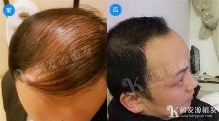 上海发友大面积植发实例4217毛囊植发效果