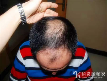 赵先生头发稀疏加密植发术后效果