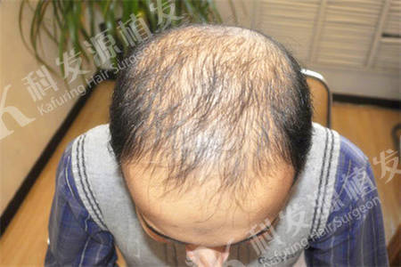 国外植发案例巴基斯坦脱发患者植发