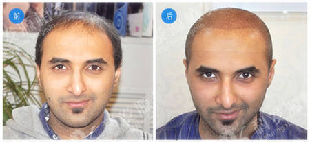 国外植发案例巴基斯坦脱发患者植发
