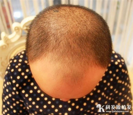 小伙脱发严重上海头发种植案例效果