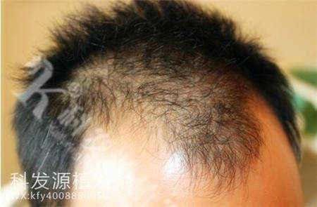 植发3076单位毛囊让邵先生的发际线恢复正常