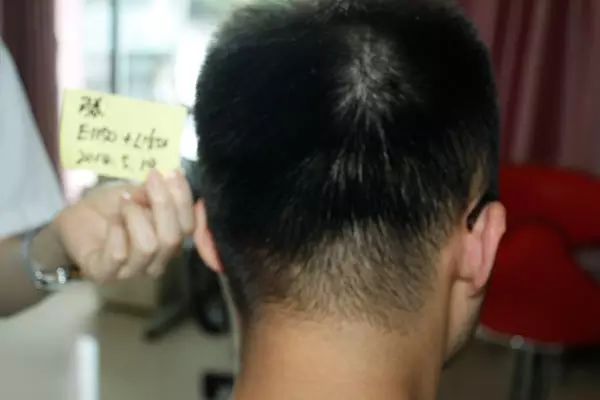留学生回国植发无痕植发2800毛囊单位7个月效果