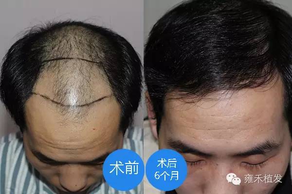 头顶脱发上海雍禾植发2600单位6个月效果！