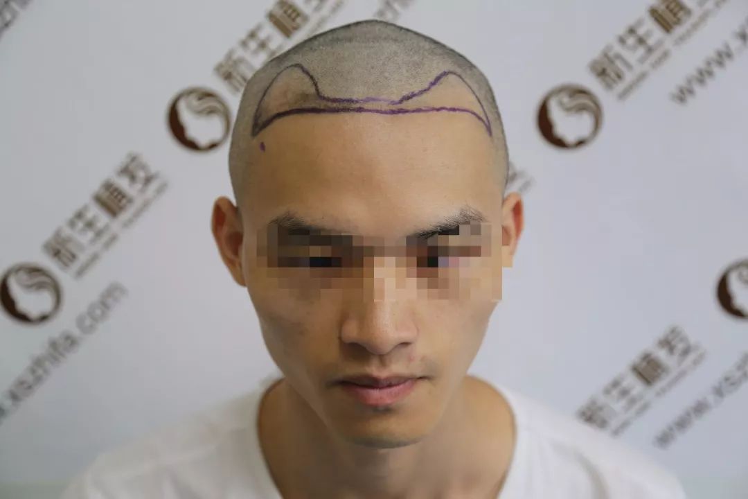 北京新生植发1500单位毛囊拥有高级脸