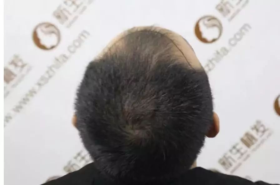冯先生植发了3600单位的头顶发际线种植