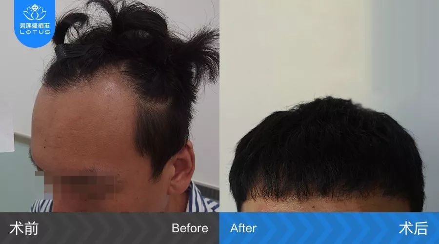 M型脱发额角退化严重发际线植发后八个月