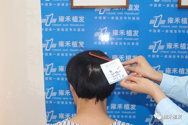 上海植发1250单位有了好头发形象