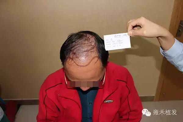 广州脱发秃顶无痕专科半年植发效果