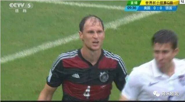 与鲁尼齐名世界杯德国球星植发出超帅效果啦