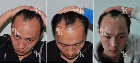 明星李涛亮植发十个月后效果3级脱发