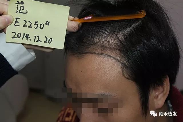 怕上当慎重一个植发医院上海头发种植2290单位