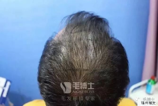 人到中年发丝去头皮残发甚油腻植发术后8个月搞定