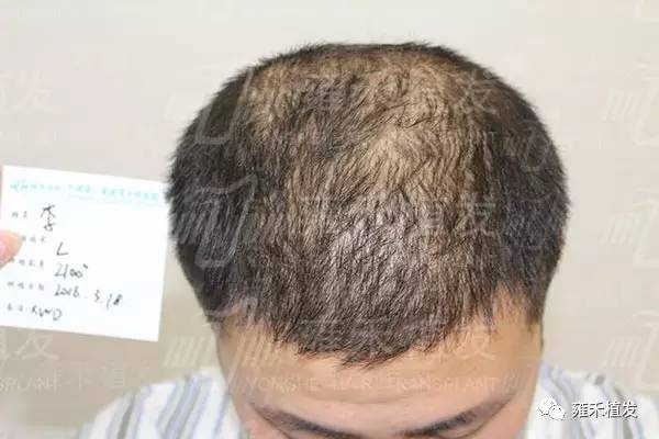 郑州头发稀稀加密植发2100单位8个月变密密！