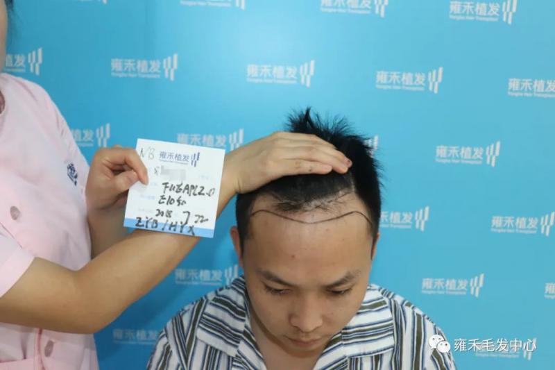 宁波雍禾植发就给小吴种植发际线不理光头植发1100单位
