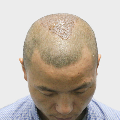 广州倍生植发治疗秃顶术后恢复效果案例