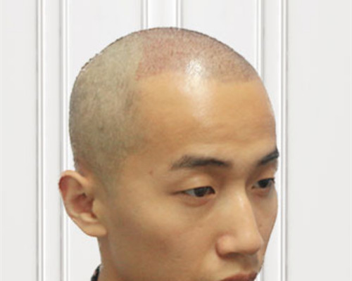 我在天津植发做稀少加密手术后效果心得分享