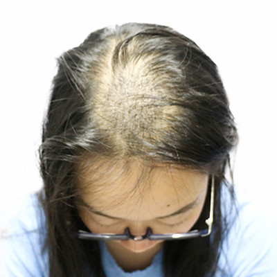 烫染发导致头发稀疏？做个加密种植就好了，术后案例效果