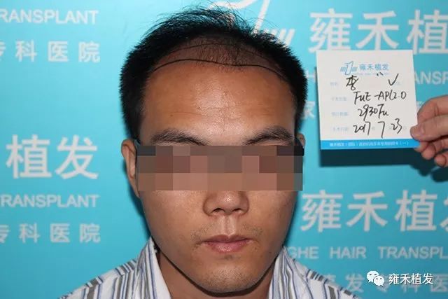 小李在武汉同城一家家地考察植发医院选定武汉雍禾