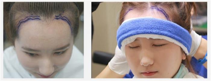 韩国植发手术替代整容真人案例李那英的神之妙算
