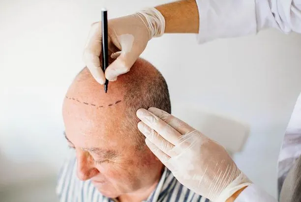 植发手术流程是怎样的？哪些人群适合植发？