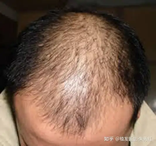 发量少适合植发吗？发量少适合植发吗？