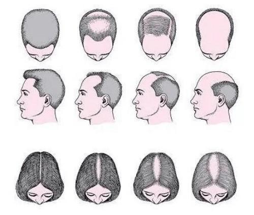 为什么秃顶的人这么多很少有做植发的？