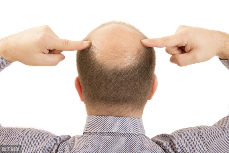 经常用脑会导致脱发吗？