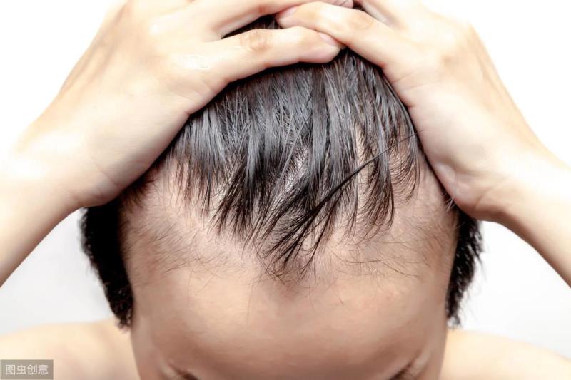 溢脂性脱发应该每天洗头么？