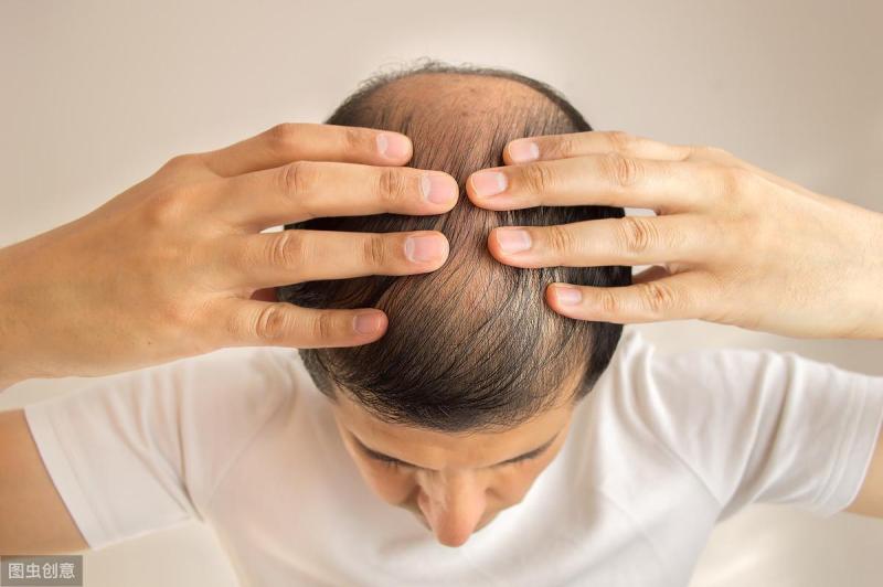 脂溢性脱发和脂溢性皮炎的关系有多大？