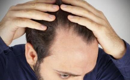 拥有遗传性脱发基因，怎样才能避免“秃发”？