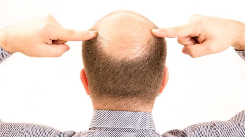 如何判断脂溢性脱发？有什么办法可以防脱？听听医生怎么说