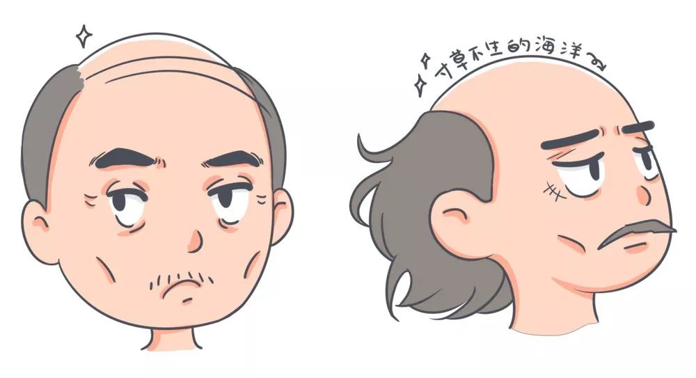 秃顶最好的4种恢复方法