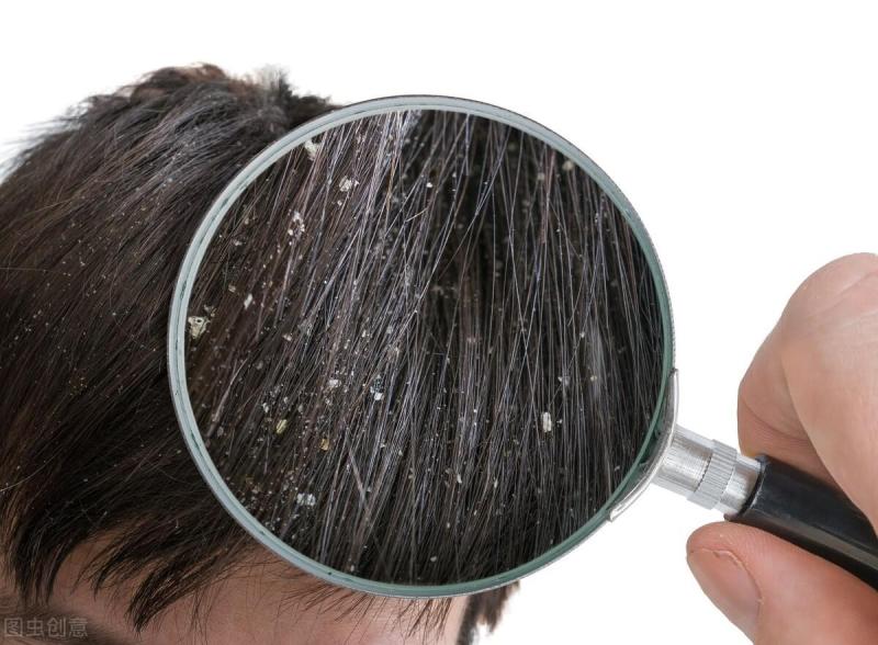 9大常见头发问题 护理方案全揭秘