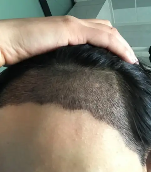 北京发际线植发，术后七个月，这算成功吗？