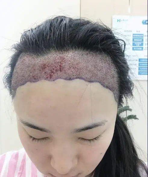 北京发际线植发，术后七个月，这算成功吗？