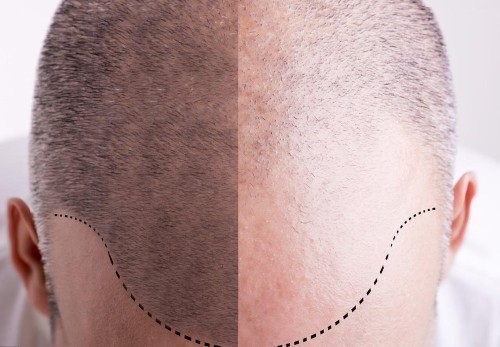 植发需要植养结合，术后脱发是置换期正常过程