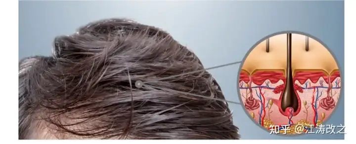 什么是脂溢性脱发？关于脂溢性脱发的全面解析