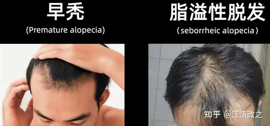 脱发对相亲的影响有多大？关于脱发的深入探究