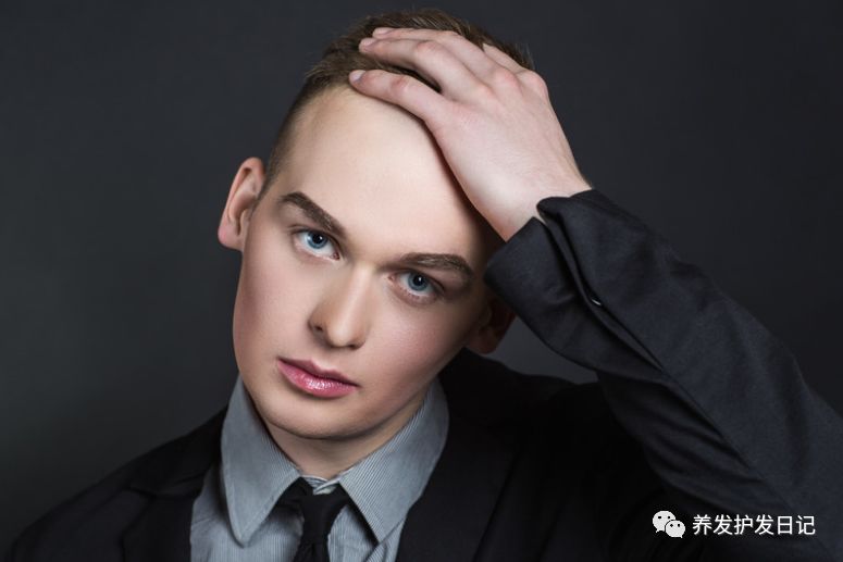 雄性激素脱发的原因，如何判断自己是雄性激素脱发？