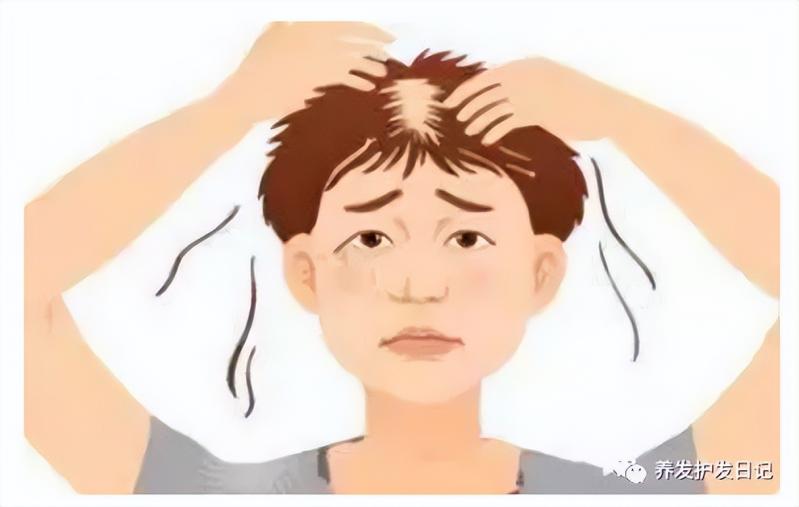 每天掉多少根头发正常？如何判断自己是否是雄性激素脱发？