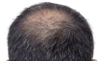 头发稀疏加密植发为何不怕伤原生发？